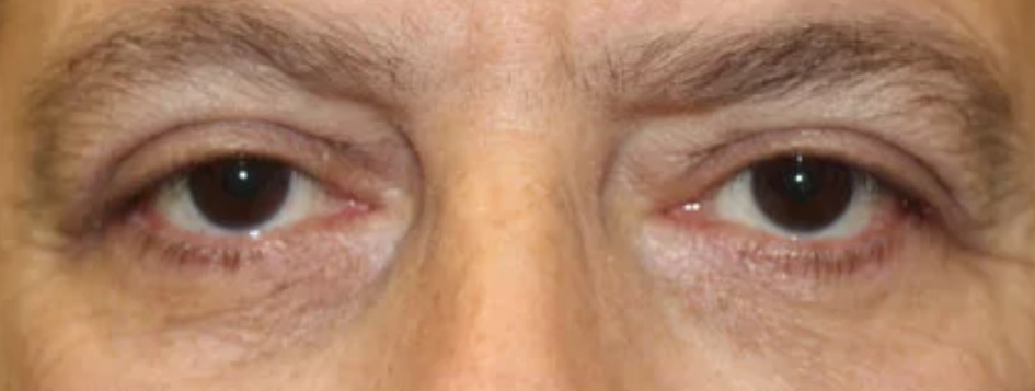 After Eyes - Front View